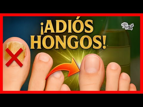 ¡ADIÓS HONGOS! Esto SÍ Elimina los Hongos de las UÑAS para siempre