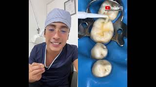 Si tienes caries ¡Esto es lo que te deben hacer! #shorts