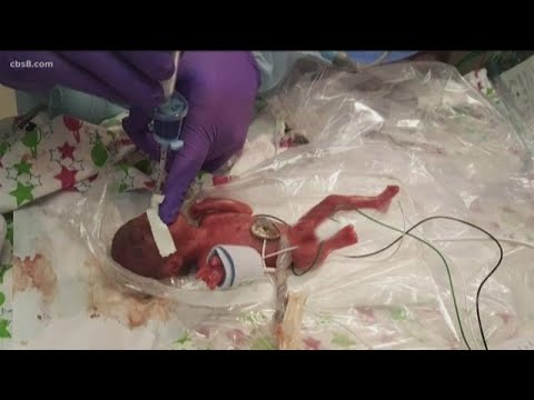 World’s smallest surviving baby born in San Diego