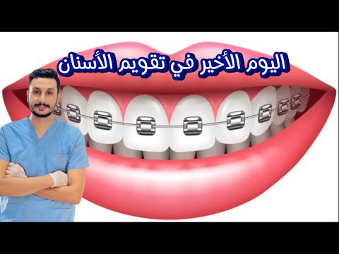 اجمل النهايات || لحظة فك تقويم الاسنان || النهاية روووعة #dr_abdullah_sultan_dentist