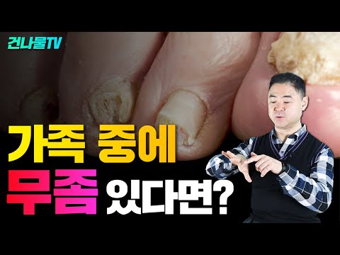 무좀 없애고 싶다면 이렇게 하세요! 완벽치료방법