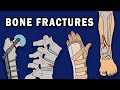 Understanding Bone Fractures and Complications