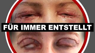 Das dubiose Geschäft der Augenlidstraffungen