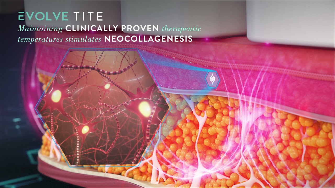 Skin treatment promoting collagen production through warmth.