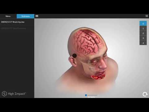 Explain Your TBI Case with the Diagnostic Slice Chooser®