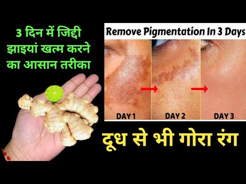 अदरक से झाइयां हटाने का जादूई तरीका II Reduce Melasma, Pigmentation, Discoloration, Blackspots