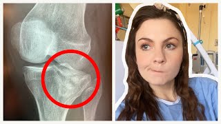 I'm In Hospital - Tibial Plateau Fracture / Broken Knee
