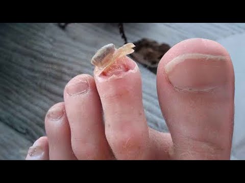 THIS was eating my toes...