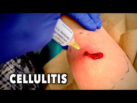 ABSCESS WITH CELLULITIS... (We had to drain it) | Dr. Paul