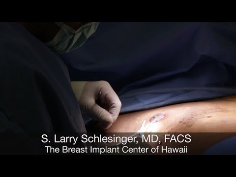 Honolulu Gynecomastia Surgery (Graphic) - Part Four - Drain, Stitch - Gynecomastia Hawaii -