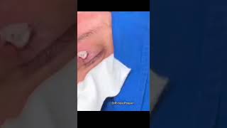 Mi lee Ahhh #shorts #drpimplepopper