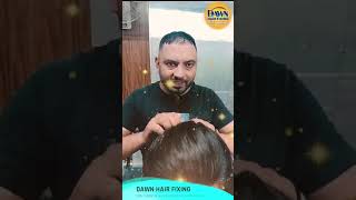 Dawn Hair Fixing Frontline Hair Patch in 2 Minutes, hair wig service islamabad rawalpindi pakistan