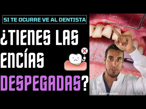 ¿Tienes las ENCÍAS DESPEGADAS? Si te ocurre ESTO deberías ir al DENTISTA