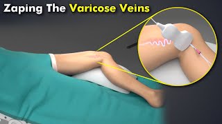 Endovenous Laser Treatment: How Laser Seals Off Varicose Veins