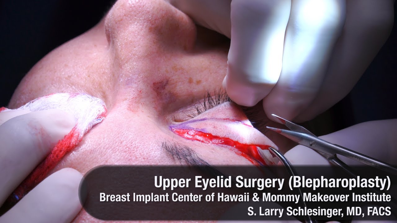 Upper Eyelid Surgery - Breast Implant Center of Hawaii