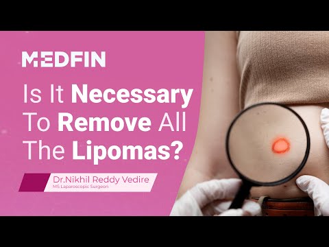 Do Lipomas Reoccur? | FAQs