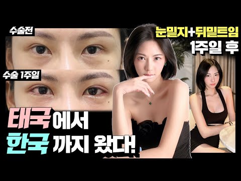 태국 인플루언서 팟나리의 눈성형 수술 4일~7일째까지! 😎😃 #눈밑지 #뒤밑트임 #눈성형후기 #뒤밑트임