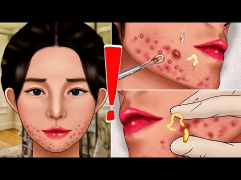 ASMR Jawline Acne Extrusion Animation due to Dirty Mask‼️, Makeup, Pimple