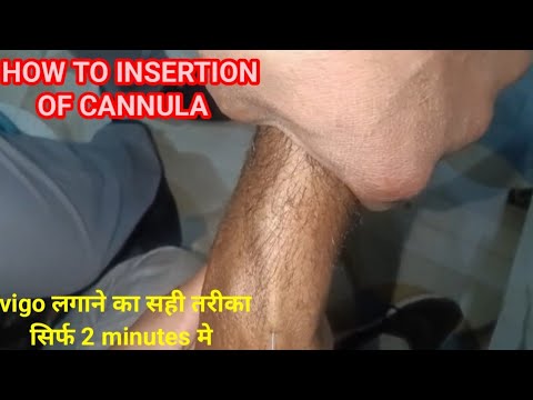 How to insert cannula?, वीगो कैसे लगाये?, cannula लगाने का सही तरीका, iv cannula #cannula