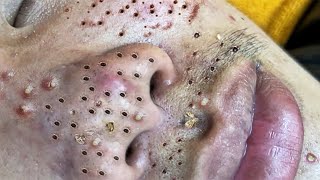 Blackhead Removal With Sac Dep Spa @100074687