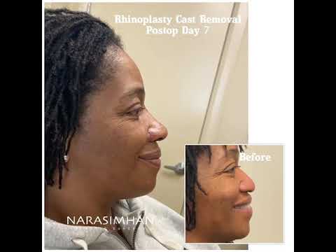 Rhinoplasty cast removal, one week postoperative.