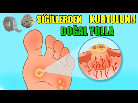 Siğillere Karşı Şaşırtıcı Ev Yapımı Çözüm - Siğillerden Doğal Yollarla Kurtulun!