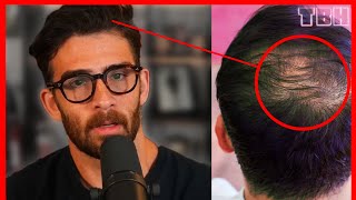 Hasan Piker is Balding | TBH EP 34
