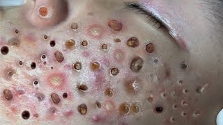 Loan Nguyen Acne Treatment 123c