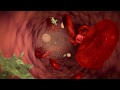 Understanding Blood Cancer and Treatment