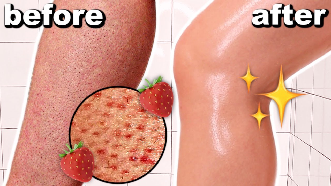 How to get rid of strawberry legs in one day! Get rid of keratosis pilaris and dark spots on legs - Audrey Victoria
