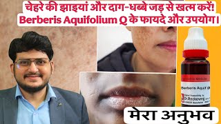 झाइयों (Melasma) के लिए Berberis Aquifolium Q | लगाने और पीने का सही तरीका जानें ! Homeopathy