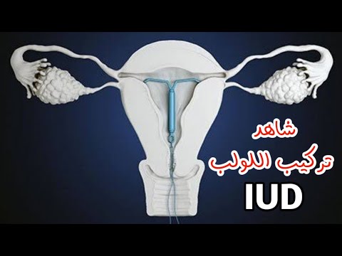 شاهد طريقه تركيب اللولب داخل الرحم لمنع الحمل للنساء _ How to insert an IUD to prevent pregnancy