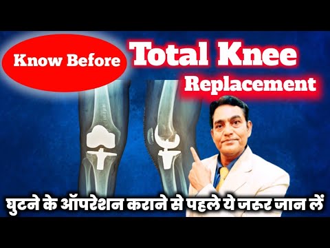 घुटने के ऑपरेशन से पहले ये जान लें | The Shocking TRUTH About Knee Replacement You Won't Believe