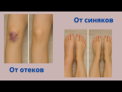 Как быстро убрать синяк дома простым способом!