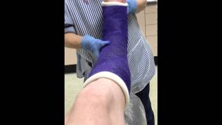 Ankle Fusion new plaster cast
