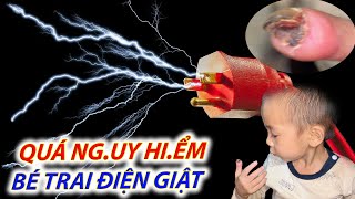 Quá Ng.uy H.iểm! Cậu Bé 3 Tuổi Bị Điện Giật Cháy Lòi Cả Xương.