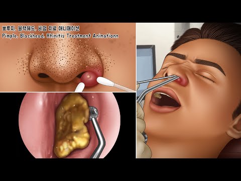 ASMR 비염으로 꽉~ 막힌 콧속 코청소 & 여드름, 블랙헤드 치료 애니메이션 | Nose Cleaning, Pimples, Blackheads
