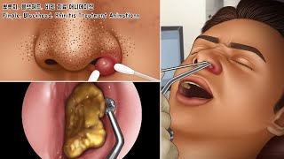 ASMR 비염으로 꽉~ 막힌 콧속 코청소 & 여드름, 블랙헤드 치료 애니메이션 | Nose Cleaning, Pimples, Blackheads