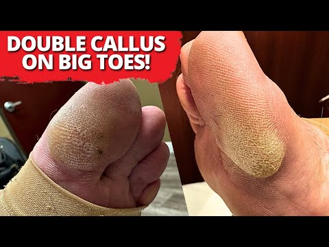 Trimming TWO THICK and DRY Calluses! (Satisfying)