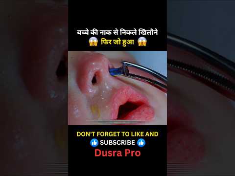 बच्चे की नाक से निकले खिलौने 😱#shorts #movieexplainedinhindi #shortsfeed