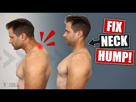 How To Fix Neck Hump At Home [Best Stretches and Exercises!]