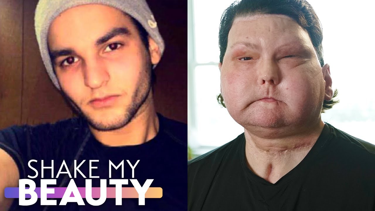 My face & double-hand transplant was the world's first - shake my beauty