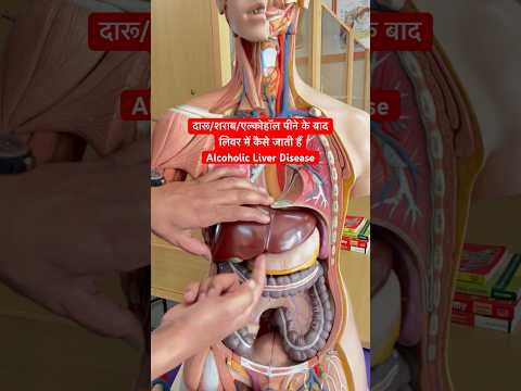 दारू/शराब/एल्कोहॉल पीने के बाद वो लिवर में कैसे जाती हैं । Alcoholic Liver Disease #shorts #viral