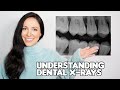Understanding Dental X-Rays Concepts