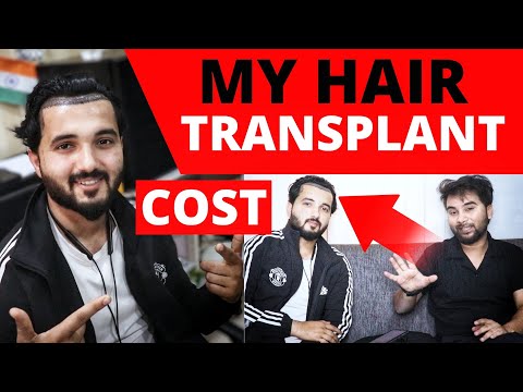 My Full Hair Transplant Cost From Day 1 🔥 My Successful Hair Transplant Journey Of 3 Years