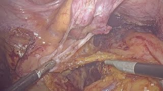 (uncut) Laparoscopic total mesorectal excision with ISR, TME part