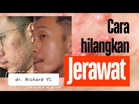 Cara gampang menghilangkan jerawat