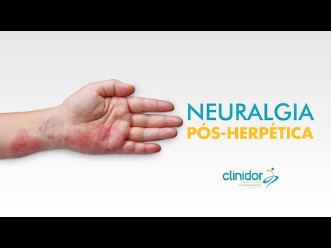 Neuralgia Pós-Herpética