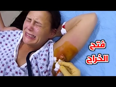 خراج تحت الابط (axillary abscess )