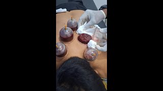 Bekam Asam Lambung dan Bengkak Jantung keenakan